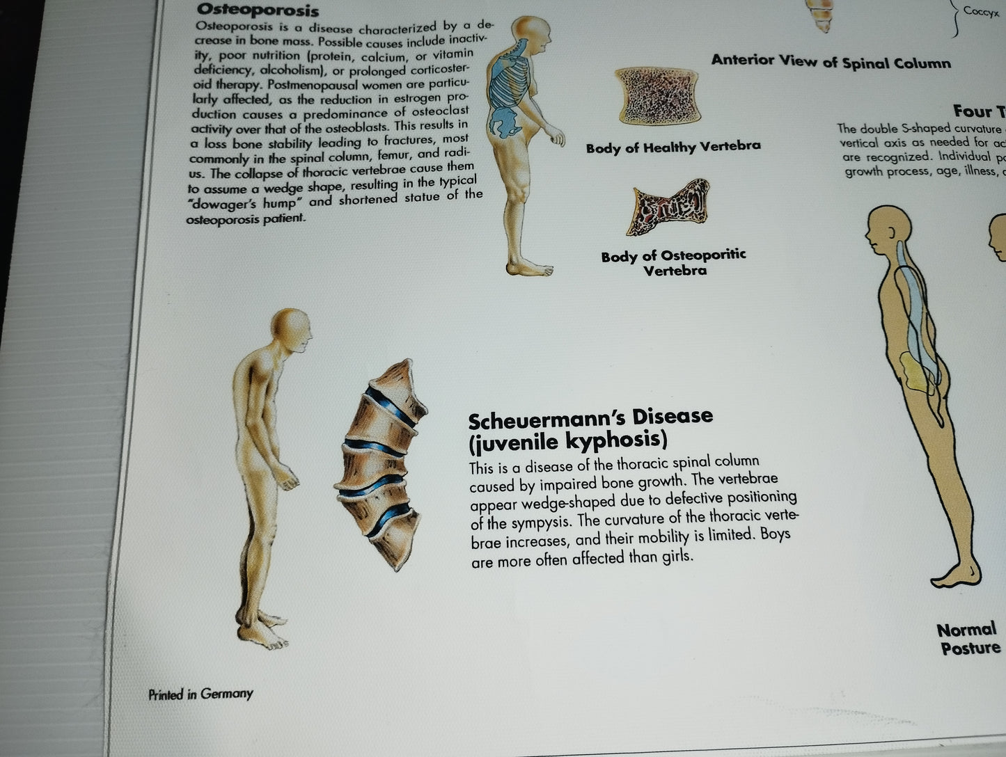 Spinal Column Anatomy and Pathology Stampa Su Tela misure 50 X 70 circa