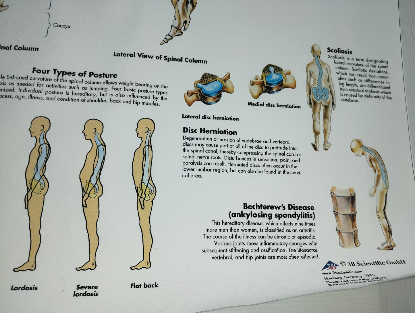 Spinal Column Anatomy and Pathology Stampa Su Tela misure 50 X 70 circa